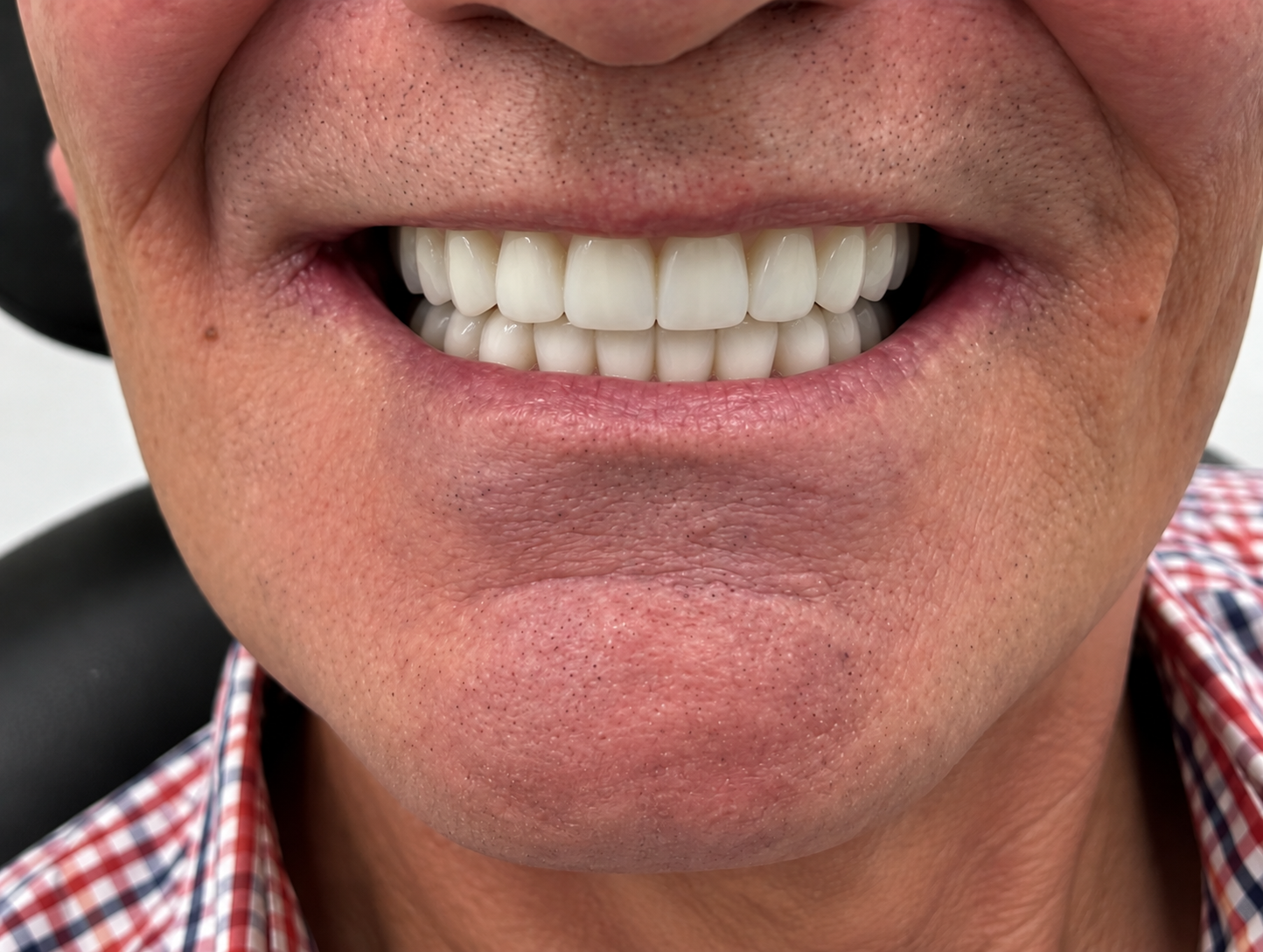 After — Natural-looking dentures