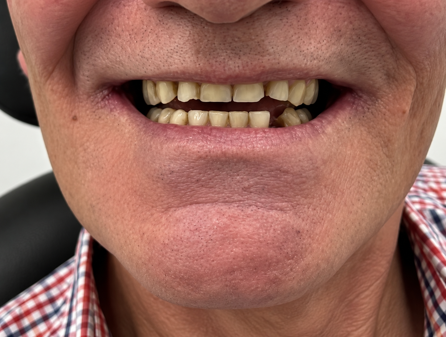 Before — Natural-looking dentures